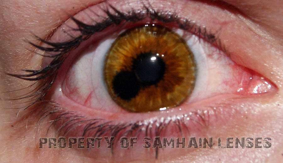 Eye Disease Pictures, Images & Photos | Photobucket